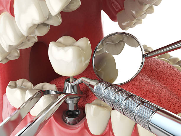 Best Emergency Wisdom Tooth Extraction in Nicoma Park, OK